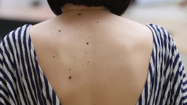Young female body, back covered with moles