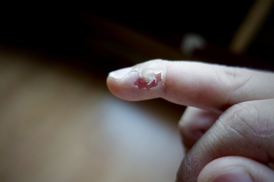 treatment wart on finger by salicylic acid, in this picture show what's happening after use salicylic acid in 3 days     