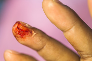 Fototapeta premium Soft focus the wound was bleeding after a broken glass.