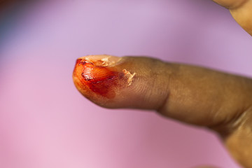  Soft focus the wound was bleeding after a broken glass.