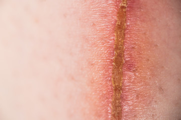a wound on the skin.