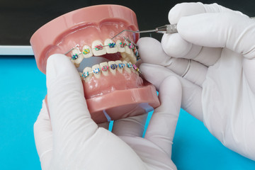 orthodontic model and dentist tool - demonstration teeth model of varities of orthodontic bracket...