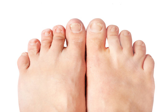 fungal nail infection (Onychomycosis). dry coarse skin of the legs (eczema)