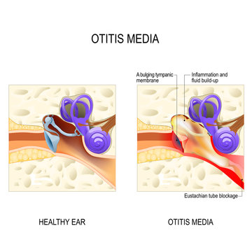 Otitis Media