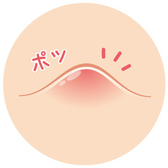 ニキビ　吹き出物