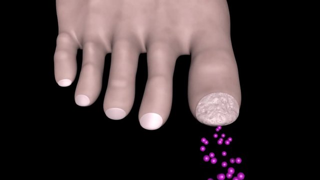 Toe nail with fungal infection, fungus treatment, healing. 3d animation