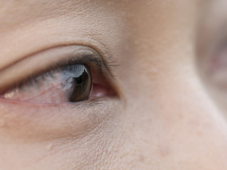 the women have a  Pinguecula in her eye