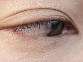 the women have a  Pinguecula in her eye