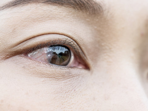 the women have a  Pinguecula in her eye