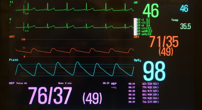 Monitor with Bradycardia on the ECG and Hypotension on the red arterial line. 