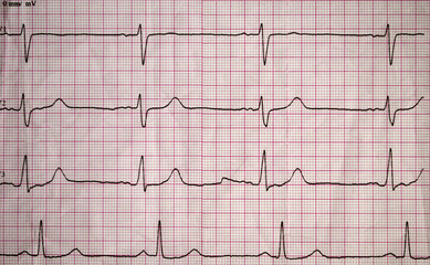 Real tape with the cardiogram of man. Image of Electrocardiogram close-up.