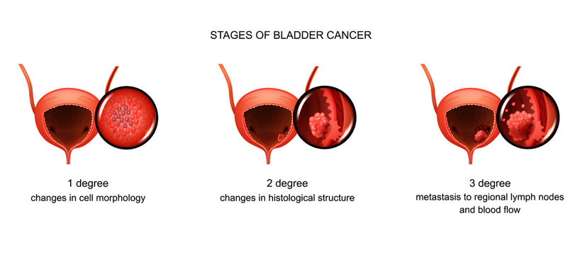 stages of bladder cancer