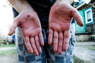 Scratched hands of the guy. Consequences of falling on hands. You need to see a doctor