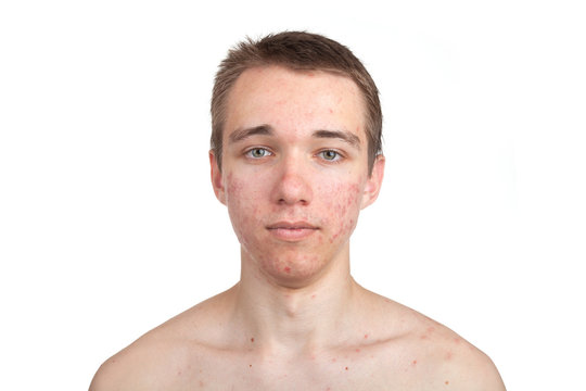 Handsome young man with skin problem