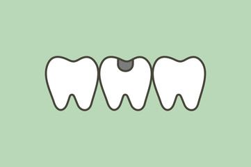 decay tooth or dental caries