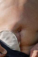 Naklejka premium Adult caucasian man with temporary stoma after bowel surgery