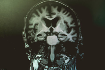 AD with CVD  white matter change