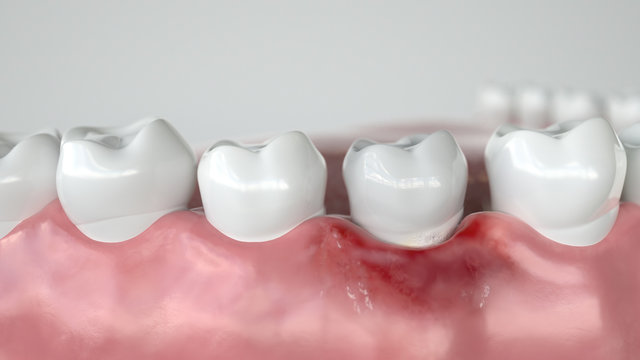 Caries in three stages - Stage 1 Gingivitis - 3D Rendering