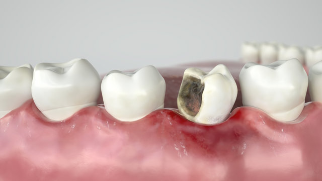 Caries in three stages - Stage 2 strong caries attack - 3D Rendering