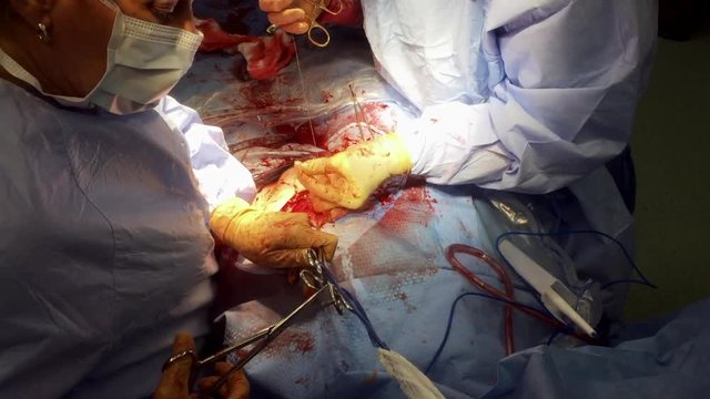 Doctors Perform Caesarean Section Surgery&nbsp;