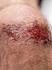 Schürfwunde am Knie nach einem Fahrradsturz