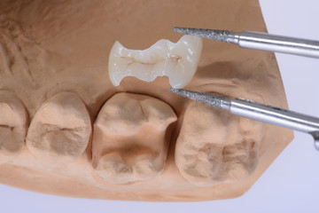 Keramikinlay vor dem Einsetzen in den natürlichen Zahn