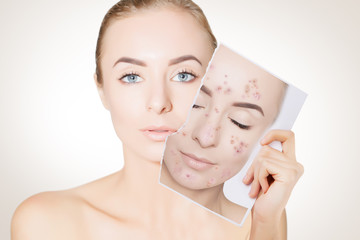 portrait of woman with clean skin holding portrait with pimpled skin