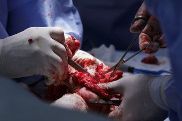 Hand amputation surgery close-up with surgical tools in use