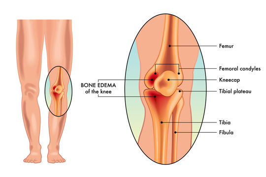 A vector medical illustration of the symptoms of a bone edema on a knee