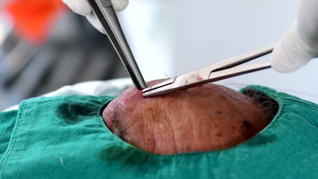 Doctor suturing cut wound at forehead. 
