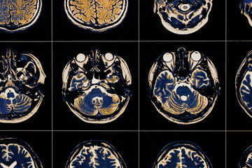 MRI image of human brain close-up