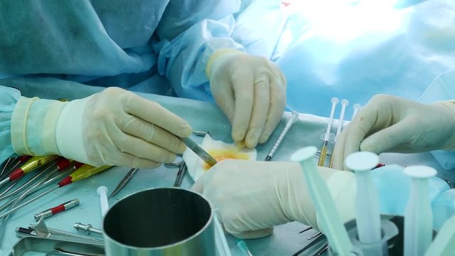 The doctor cleans the human fat collected in the thigh of the patient, on the table with the instruments during the plastic surgery
