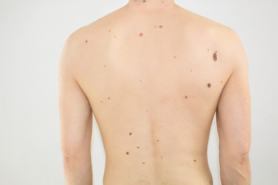 Back of a man in moles