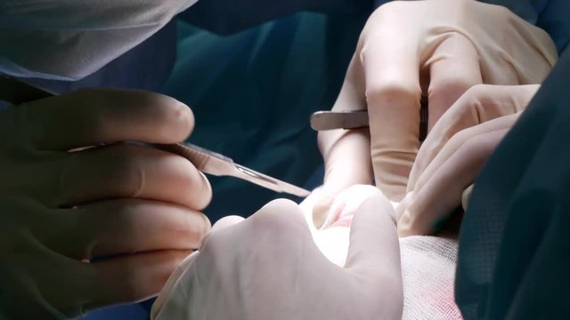The doctor's hands make an incision with a scalpel on the patient during the operation. The nurse holds the gauze around the notch. Plastic surgery for blepharoplasty