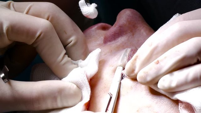 The doctor using scissors to separate the skin from the patient's face during plastic surgery ao eye rejuvenation. Plastic surgery for blepharoplasty