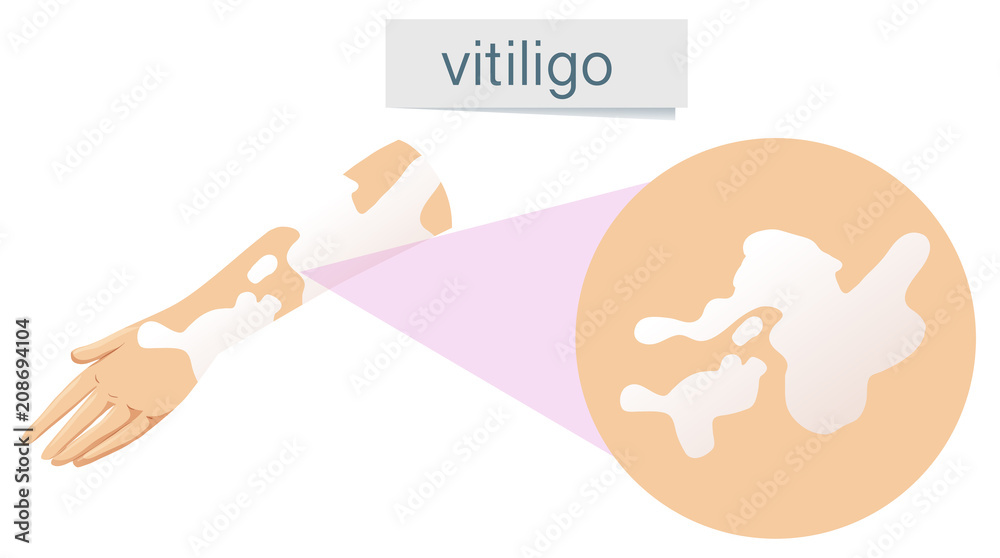 Poster a vector of vitiligo on skin