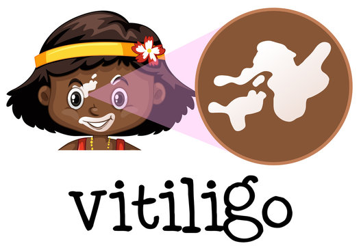 Human Medical Education of Vitiligo
