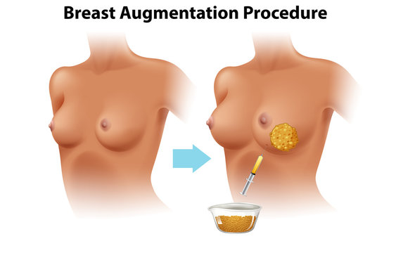 A Set of Female Breast Augmentation