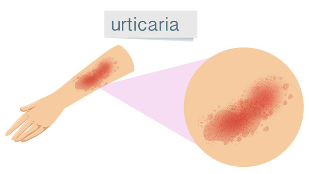 A Human Skin Problem Urticaria