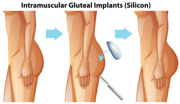 Intramuscular Gluteal Implants on White Background
