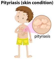 magnified pityriasis on young boy