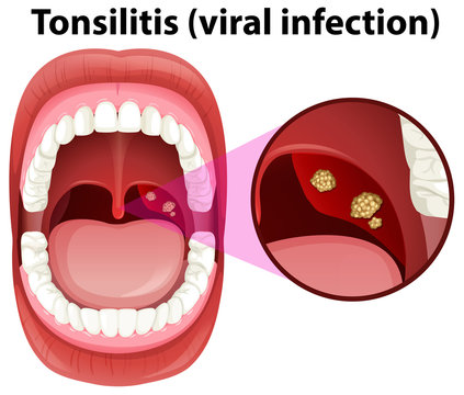 A Human Mouth Tonsillitis Infection