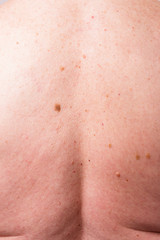 Naklejka premium the doctor examines the birthmarks on the man's body