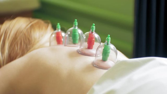 Traditional Chinese Medicine Cupping process. Hijamah Cups on back of female patient woman in Acupuncture therapy. Chinese Traditional treatment. Medical cupping therapy equipment.