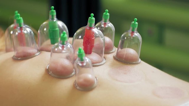 Traditional Chinese Medicine Cupping process. Hijamah Cups on back of female patient woman in Acupuncture therapy. Chinese Traditional treatment. Medical cupping therapy equipment.