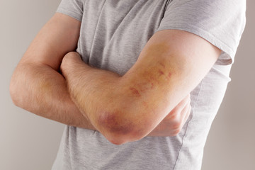 Sport injury.