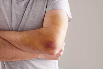 Sport injury.