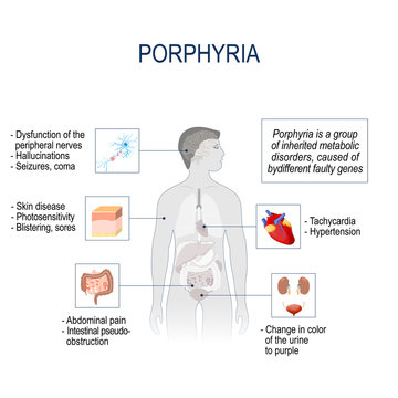 Porphyria. Signs and symptoms. Vector illustration for medical use.