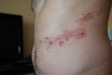 close up on herpes zoster on the stomach