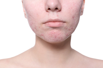 Fototapeta premium Young woman with acne problem on white background
